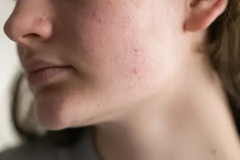 Primo piano del viso di una persona con rossori e imperfezioni, indicativi di una barriera cutanea danneggiata.