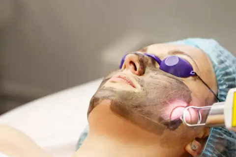 Donna con maschera al carbone per un trattamento laser. Il carbon peel prima e dopo trasforma la pelle.