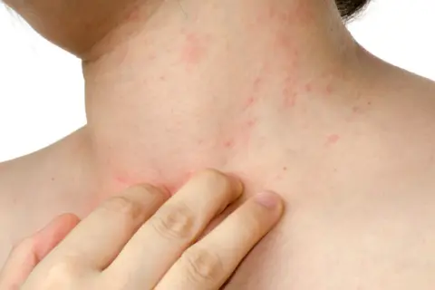 Pelle arrossata e irritata sul collo e sul petto, con piccole macchie rosse, indicative di dermatite da stress.