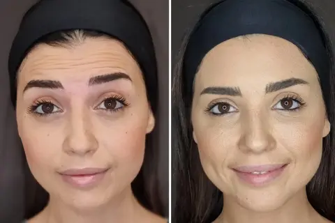 Confronto tra fronte con rughe e fronte levigata, mostrando la differenza tra botox e filler.