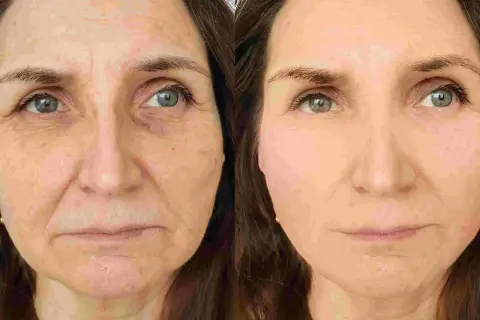 Prima e dopo: un lifting occhi che trasforma rughe profonde in pelle liscia e luminosa.