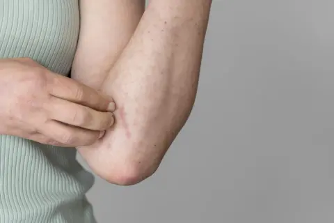 Braccio con eritema e puntini rossi, segno di possibile allergia al sudore.