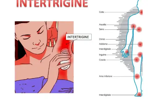 Intertrigine: rossore e puzza sotto il seno e in altre zone del corpo.