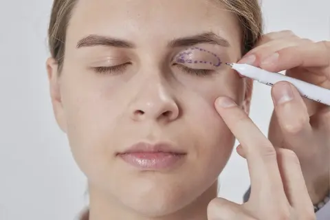 Medico disegna contorno per filler palpebre cadenti.