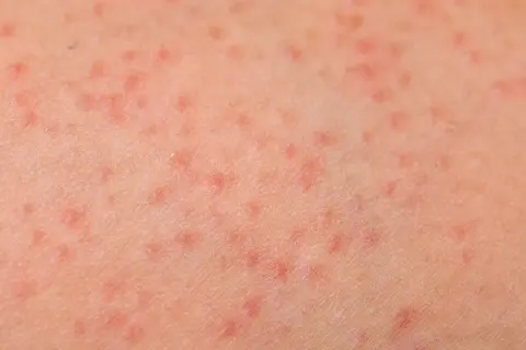 Pelle con eritema solare, caratterizzata da numerosi puntini rossi che indicano un'irritazione cutanea.