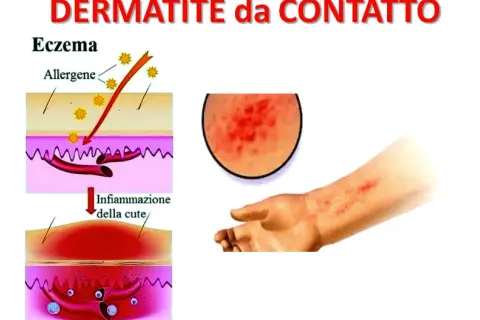 Illustrazione della dermatite da contatto: allergeni penetrano nella pelle causando infiammazione, con un ingrandimento di un'eruzione cutanea e un braccio affetto.