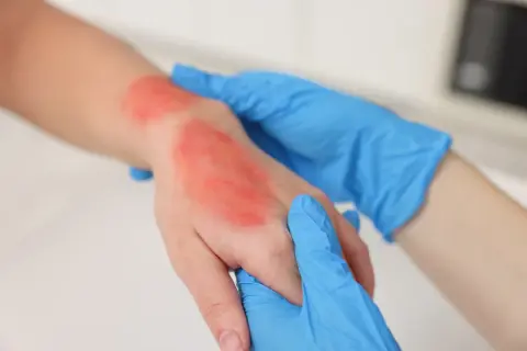 Mano con ustione rossa e infiammata, assistita da mani con guanti blu. Impara cosa fare in caso di ustione.