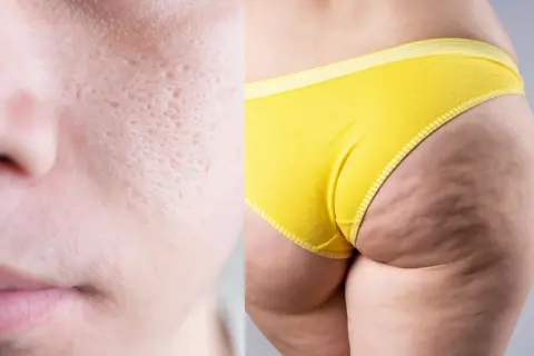 Primo piano di pelle con pori dilatati e cicatrici da acne, affiancato da una coscia con evidente **mento a buccia d'arancia** e culotte gialle.