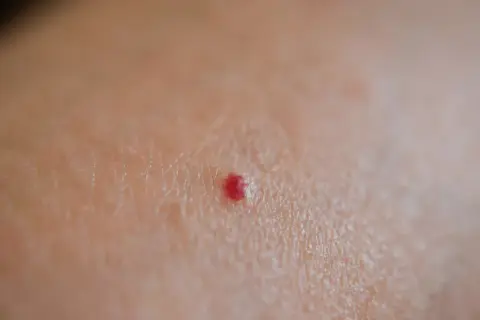 Primo piano della pelle con un piccolo punto rosso, simile a micro bollicine sulla pelle.