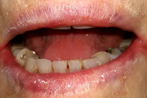 Labbra arrossate e screpolate, con segni di cheilite angolare agli angoli della bocca. Denti visibili, alcuni con macchie.
