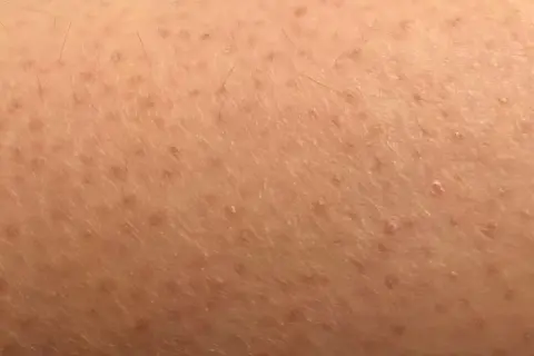 Pelle con cheratosi pilare, piccoli puntini rossi e peli incarniti. Scopri come curarla.
