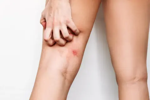 Mano che si gratta la coscia irritata, cercando rimedi naturali per lo sfregamento cosce.