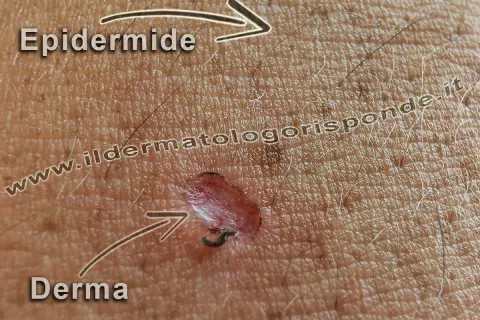 Ingrandimento della pelle che mostra l'epidermide superficiale e la derma sottostante, con una piccola lesione.