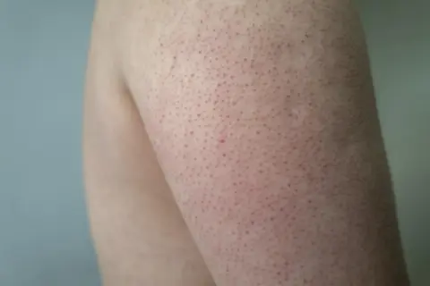 Pelle con follicolite alle gambe, piccoli puntini rossi e peli incarniti. Scopri come curarla per una pelle liscia e sana.