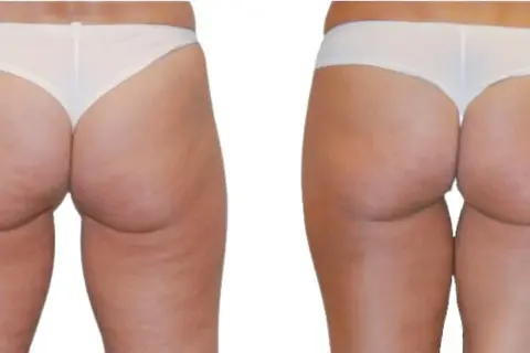 Confronto radiofrequenza glutei prima e dopo: pelle più liscia e tonica.