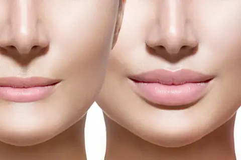 Prima e dopo: labbra più piene e definite, un esempio di come rimpolpare le labbra in modo naturale per un sorriso radioso.