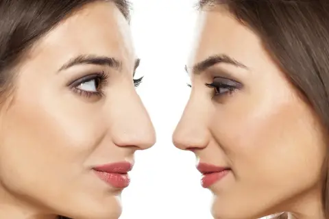 Profilo di due donne, una con naso più pronunciato, l'altra con naso modificato. Attenzione al rinofiller rischio cecità.