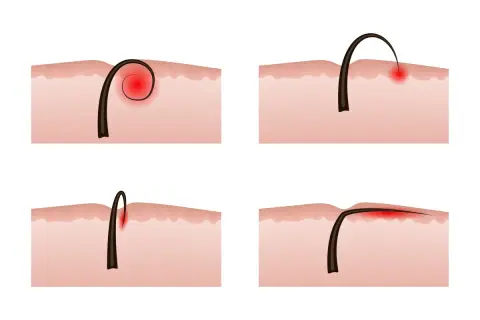 Illustrazione di peli incarniti e infezione cutanea. Diverse fasi di un pelo che cresce sotto la pelle, causando infiammazione e rossore.