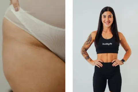 Dettaglio di culotte de cheval, causa di inestetismi della pelle, accanto a una donna sorridente in abbigliamento sportivo.