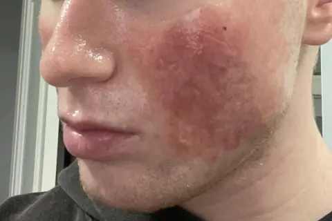 Viso con rossore intenso e pelle lucida dopo trattamento laser CO2 frazionato.