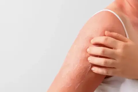 Spalla e collo arrossati con desquamazione, segno di cheratosi della pelle. La mano sfiora la zona irritata.