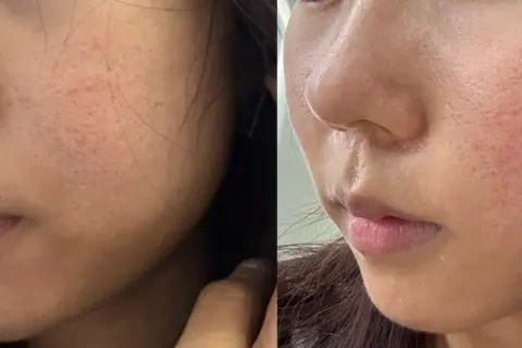 Confronto laser frazionato prima e dopo: pelle con pori dilatati e rossori prima, pelle più liscia e uniforme dopo il trattamento.