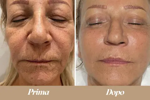 Confronto prima/dopo: il terzo superiore del viso mostra una pelle più liscia e luminosa dopo il trattamento.