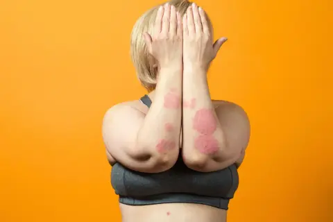 Donna con chiazze rosse sulle braccia, segno di psoriasi da stress. Copre il viso con le mani.