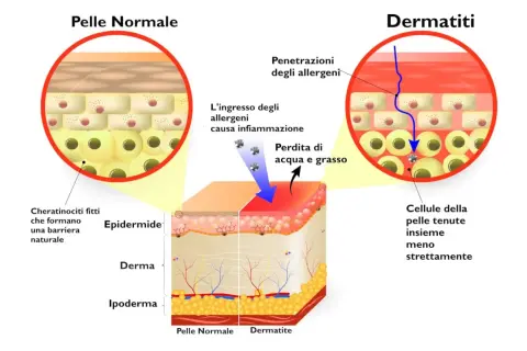 Confronto tra pelle normale e dermatite: la pelle sana ha cheratinociti fitti, mentre la dermatite mostra penetrazione di allergeni, infiammazione e perdita di acqua e grasso.