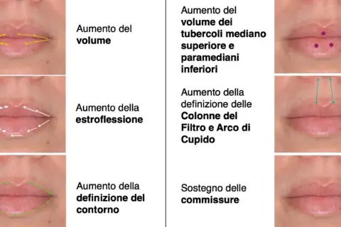 Esempi di filler labbra fatto male: labbra gonfie, asimmetriche o con contorni innaturali. Illustrazioni mostrano correzioni.