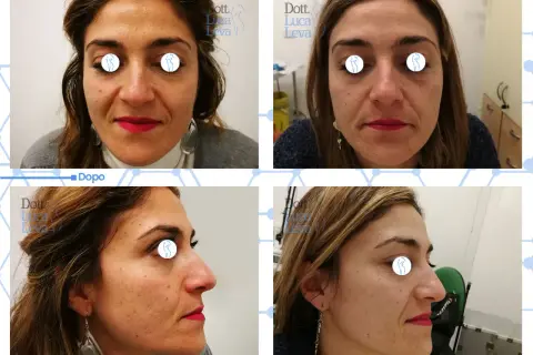Prima e dopo un trattamento di laser ablativo viso per migliorare la texture della pelle e ridurre le imperfezioni.
