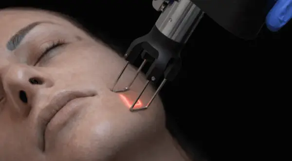 Trattamento viso con laser per ridurre le rughe. Un manipolo emette un fascio luminoso sulla pelle.