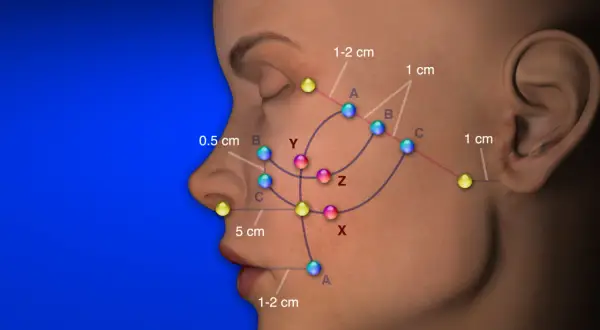 Punti riassorbibili colorati indicano aree di trattamento sul viso, con distanze misurate.