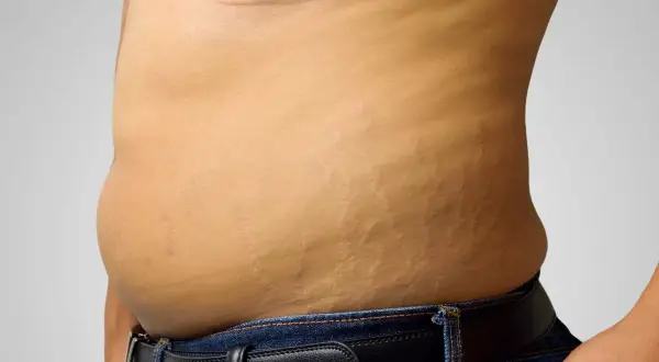 Addome con smagliature, un promemoria che la pelle è un organo che cambia.