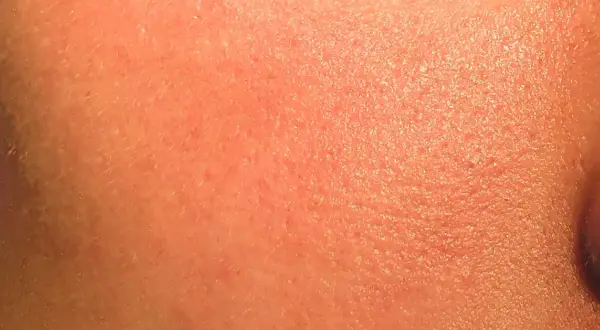 Pelle arrossata e secca, con piccole scaglie visibili, possibili effetti collaterali del retinolo.