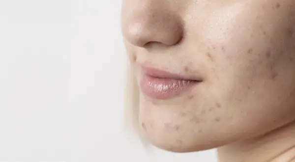 Primo piano del viso di una giovane donna con segni di acne. La pelle mostra imperfezioni, rossori e brufoli, evidenziando la necessità di una **pulizia viso acne**.
