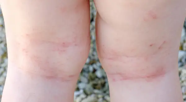 Gambe di bambino con eritema e piccoli puntini rossi, forse dovuti alla sudamina da prurito dopo una giornata al mare.