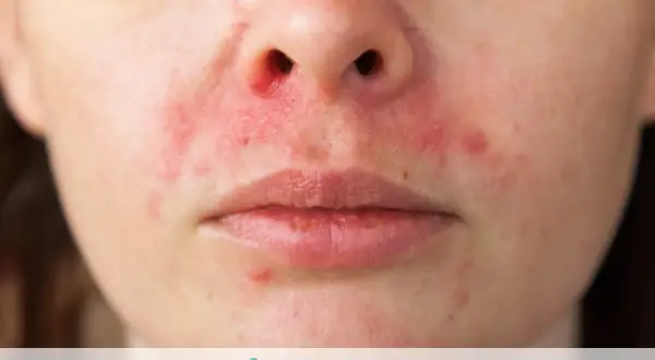 Viso arrossato e irritato, con piccole pustole e zone squamose, indicative di lieve dermatite seborroica viso.
