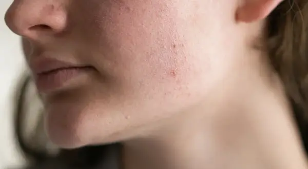 Primo piano del viso di una persona con rossori e imperfezioni, indicativi di una barriera cutanea danneggiata.
