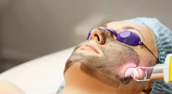 Donna con maschera al carbone per un trattamento laser. Il carbon peel prima e dopo trasforma la pelle.