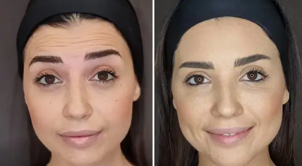 Confronto tra fronte con rughe e fronte levigata, mostrando la differenza tra botox e filler.