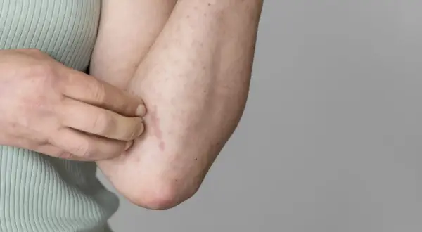 Braccio con eritema e puntini rossi, segno di possibile allergia al sudore.