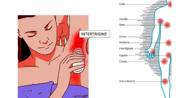 Intertrigine: rossore e puzza sotto il seno e in altre zone del corpo.