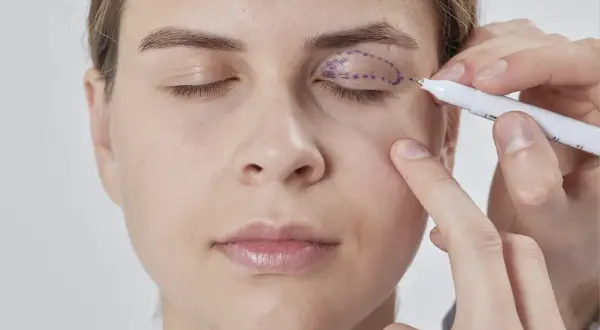 Medico disegna contorno per filler palpebre cadenti.