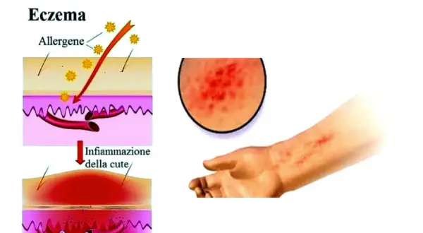 Illustrazione della dermatite da contatto: allergeni penetrano nella pelle causando infiammazione, con un ingrandimento di un'eruzione cutanea e un braccio affetto.