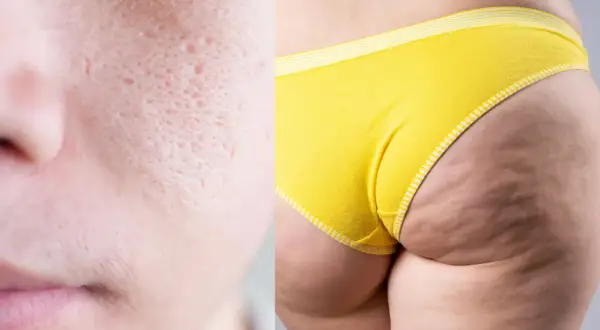 Primo piano di pelle con pori dilatati e cicatrici da acne, affiancato da una coscia con evidente **mento a buccia d'arancia** e culotte gialle.
