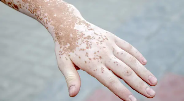 Mano con psoriasi macchie bianche e marroni, un dettaglio della pelle che mostra la vitiligine.