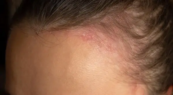 Fronte con arrossamento e squame, tipici della dermatite seborroica. La pelle appare irritata e leggermente desquamata vicino all'attaccatura dei capelli.