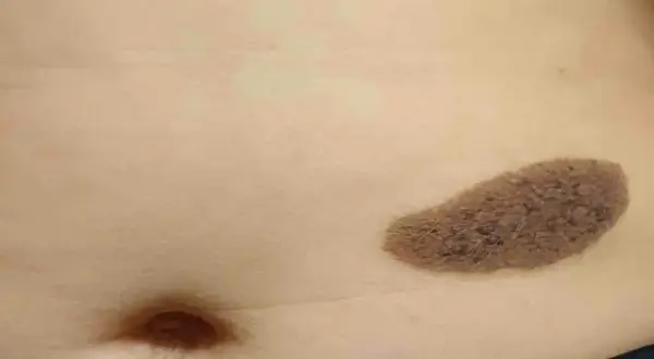 Macchia marrone sulla pelle tipo bruciatura, con una texture ruvida e irregolare, vicina all'ombelico.