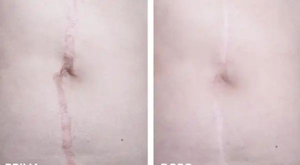 Confronto laser cicatrici prima e dopo: la cicatrice è visibilmente ridotta e meno evidente dopo il trattamento.
